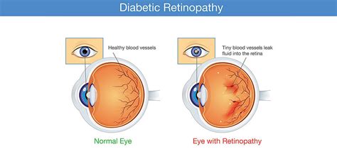 Advanced Ayurveda For Treating Diabetic Retinopathy