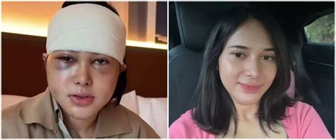9 Potret Dilan Janiyar Seleb Tiktok Usai Oplas Di Korea Tak Banyak