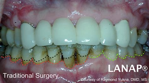 Why Is Lanap Making The Difference Preserve Your Teeth