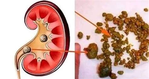 Limpia Tu Ri N Y Expulsa Hasta La Ltima Piedra Viral Salud