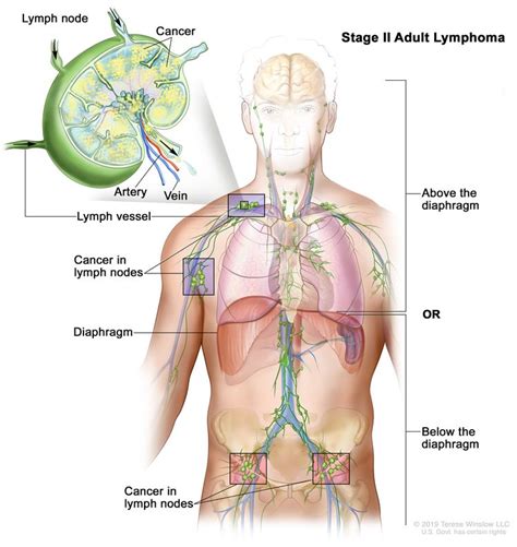 Non Hodgkin Lymphoma Vanderbilt Ingram Cancer Center