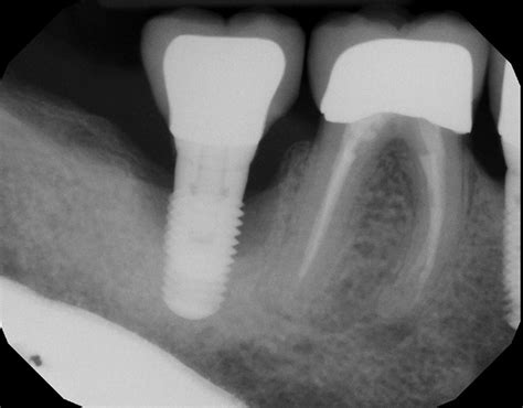 Peri Implantitis Treatment River Valley Periodontics And Implant Dentistry