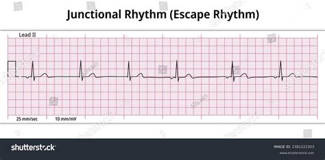 Ecg Junctional Rhythm Escape Rhythm 8 Stock Vector (Royalty Free) 2381222303 | Shutterstock