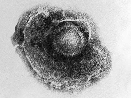 Abnormal Development - Varicella Zoster Virus - Embryology