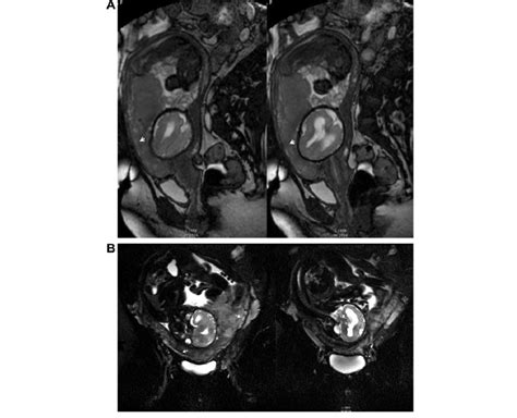 Placenta Previa Complete Anterior Mr Imaging A Sagittal B Ffe And Download Scientific