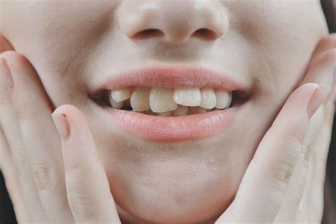 What Causes Crooked Teeth And How Does Teeth Straightening Work Nudental