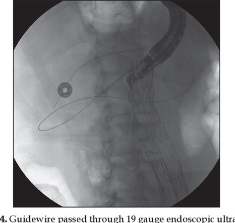 Figure From Endoscopic Ultrasound Guided Transmural Drainage Of