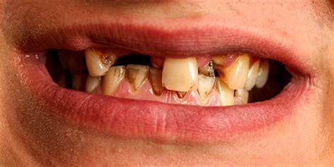 Meth Mouth The Effects Of Meth Addiction Northridge Addiction