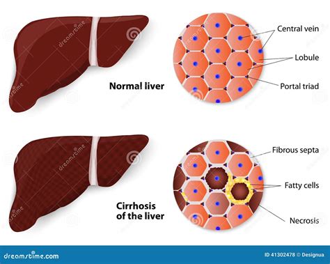 Hígado sano y cirrosis ilustración del vector Ilustración de