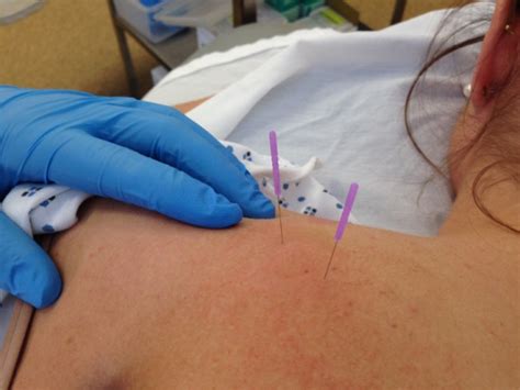 Dry Needling De And Md Physical Therapy And Rehabilitation