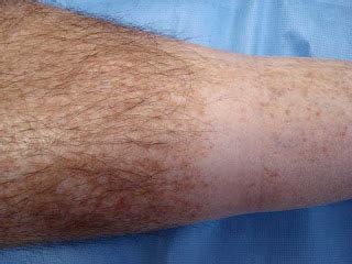 Virtual Grand Rounds in Dermatology - Primary Care: Perplexing Dermatosis of Legs