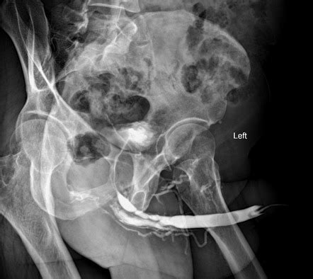 Venous Intravasation In Retrograde Urethrography Radiology Case