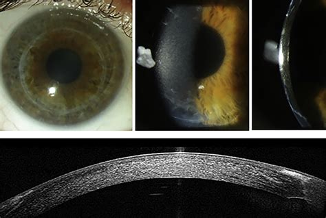 Corneal Clouding In Diffuse Illumination A B And In Optical Section