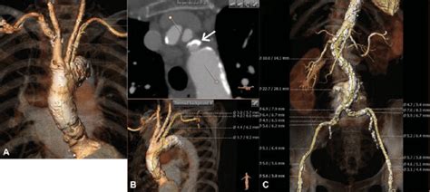 Computed Tomography Showing The Porcelain Ascending Aorta A