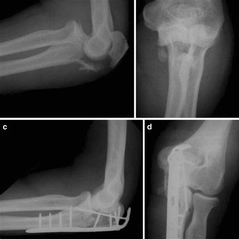 A 38 Year Old Man Sustained An Anterior Transolecranon Download Scientific Diagram