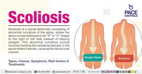 Scoliosis - Symptoms, Causes, Types, Treatment