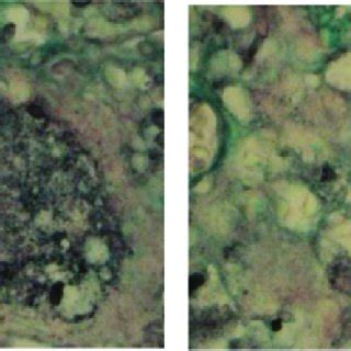 (PDF) A case of disseminated sporotrichosis caused by Sporothrix ...