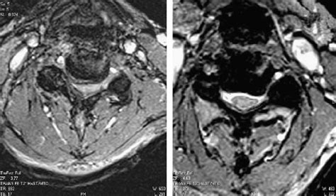 T2 Weighted Axial Magnetic Resonance Imaging Scans Of Cervical Spine