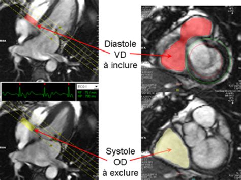 Volumes Et Fonction Vd Irmcardiaque
