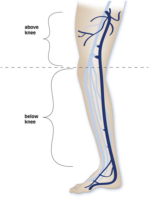 Vein Patch Closure Using Below The Knee Greater Saphenous Vein For