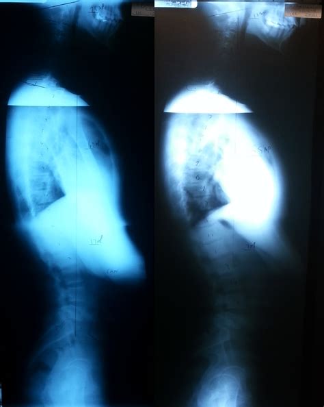 Distance Runner & Hip Pain Receives Gonstead Chiropractic in San Diego