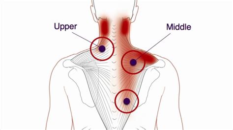 What are trigger points? — Flow Point Acupuncture- Red Bank Acupuncture