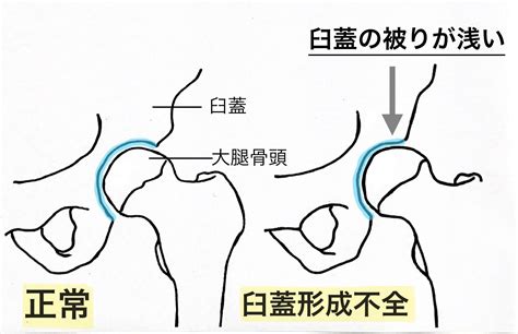 臼蓋形成不全と言われたことはありますか？ リペアセルクリニック東京院