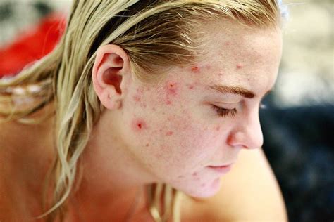 Acne Descrizione Della Patologia Ed Approfondimenti