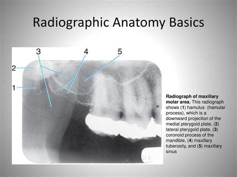 Pterygoid Plate Radiograph