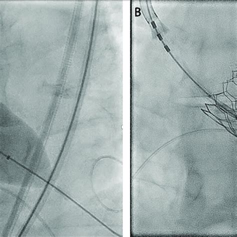 Perioperative Fluoroscopy Showing A Dilation And B Fully Expanded Download Scientific