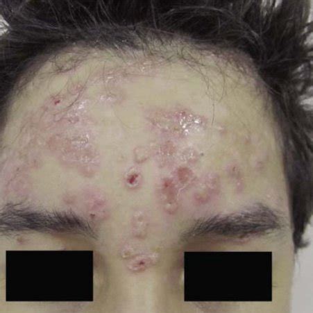 linear iga dermatosis erosions  peripherally disposed vesicles