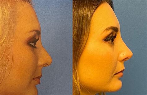 Revision Rhinoplasty Archives Adam Bryce Weinfeld Md Board