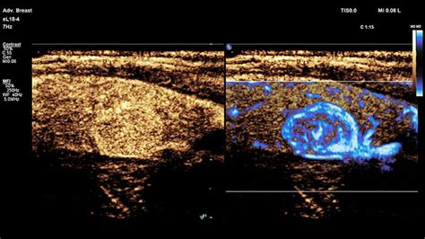 CEUS Contrast Enhanced Ultrasound Philips Healthcare