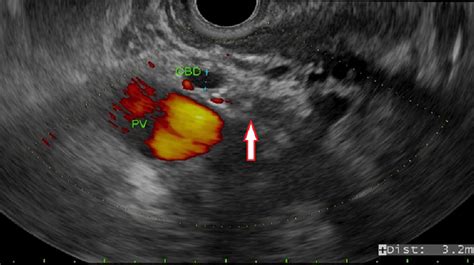 Endoscopic Ultrasound Eus Findings In The Patient With Groove Download Scientific Diagram