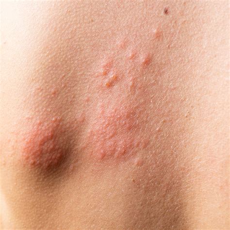 Hives Vs Eczema