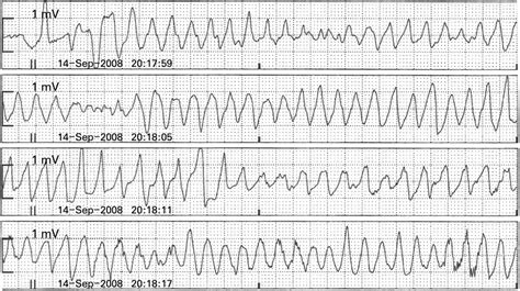 Torsades De Pointes Rhythm Strip