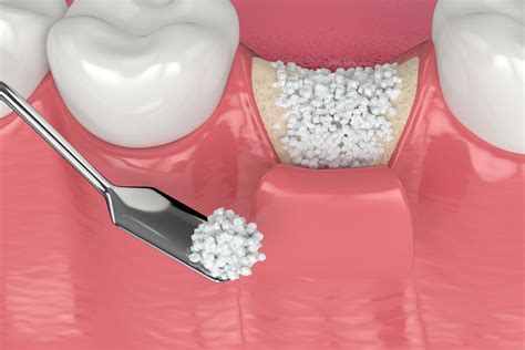 Types of bone grafts for dental treatment - The Dental District