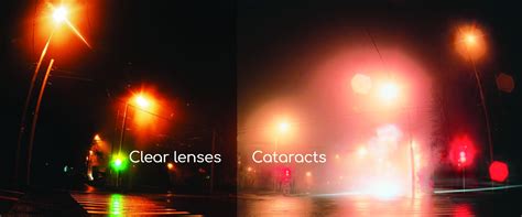 Warning Signs Cataract Surgery Sa