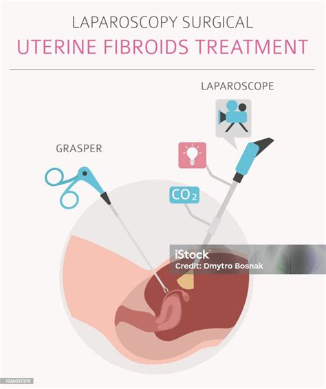 Uterine Fibroids Ginecological Medical Desease In Women Infographic