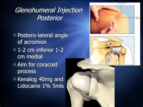 Ppt Shoulder Assessment And Injection Powerpoint Presentation Free