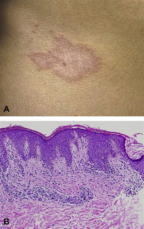 Annular Lichenoid Dermatitis Of Youth In An American Boy Journal Of