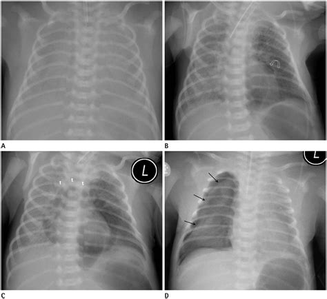 Interpretation Of Neonatal Chest Radiography