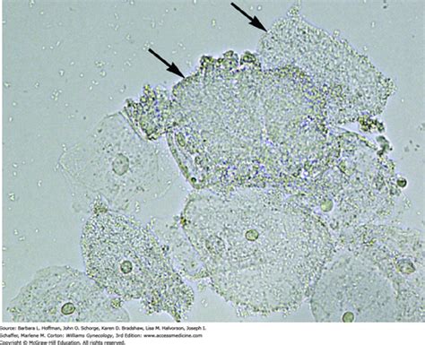 Chapter 3 Gynecologic Infection Obgyn Key