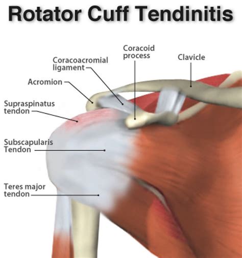 Shoulder Tendonitis