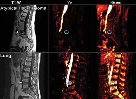 Hemangioma Mri