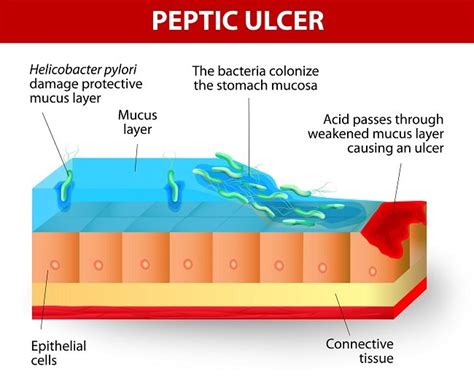 Ulkus Peptikum Patofisiologi Diagnosis Penatalaksanaan Alomedika