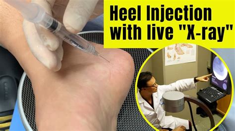 Heel Injection With Live X Ray Plantar Fasciitis Youtube