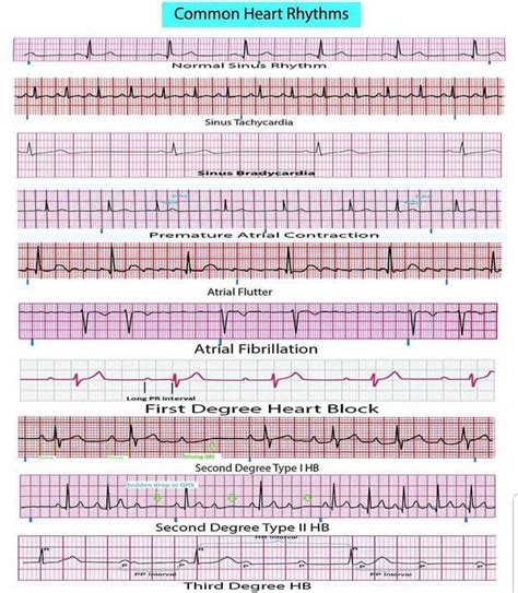 Common Heart Rhythms Ekg Interpretation Ekg Ekg Interpretation