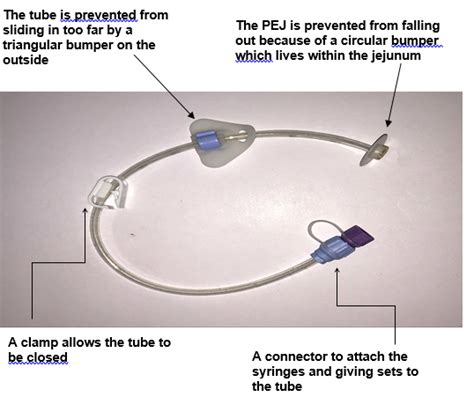 Looking After Your Percutaneous Endoscopic Jejunostomy Tube PEJ CUH