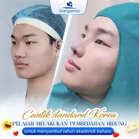 pembedahan rhinoplasty korea rahsia  memiliki bentuk hidung ala